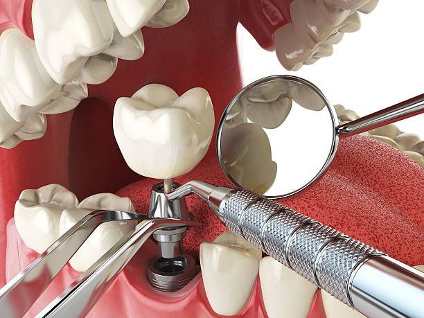 Best Emergency Dental Care for Broken or Chipped Teeth in Marysville, OH